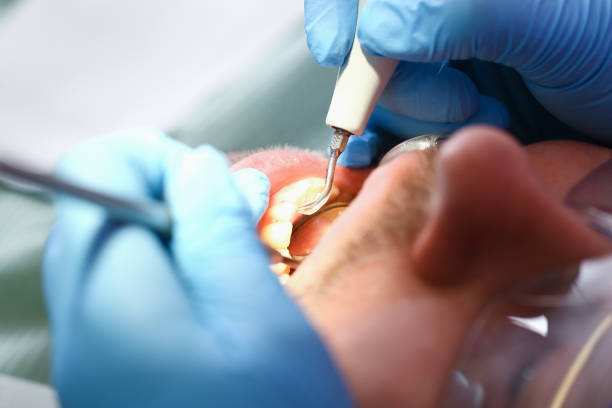 Best Emergency Tooth Extraction in Flat Rock, NC